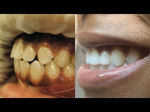 INVISALIGN BEFORE AND AFTER