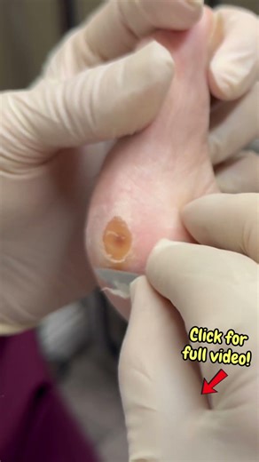 Part 5: Unusual Corn Buried Deep in the Side of the Toe | Extreme Corn Removal #satisfyingshorts
