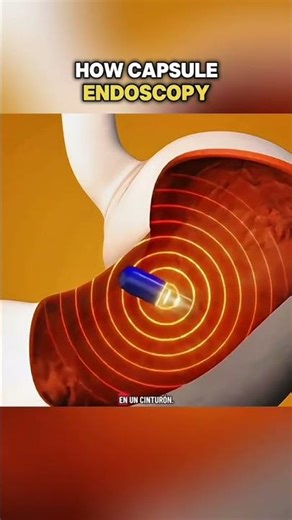 How capsule endoscopy(3DAnimatio)