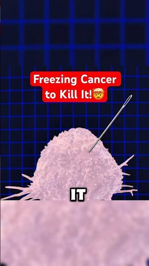 Doctors Can Now Freeze Cancer