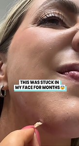 18K views · 81 reactions |  You won't believe what came out of this one... #pimplepop #satisfying | Pimple Popping | Facebook