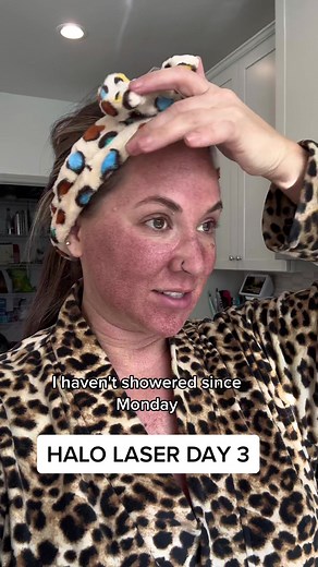Halo Laser Treatment: Day 3 Experience