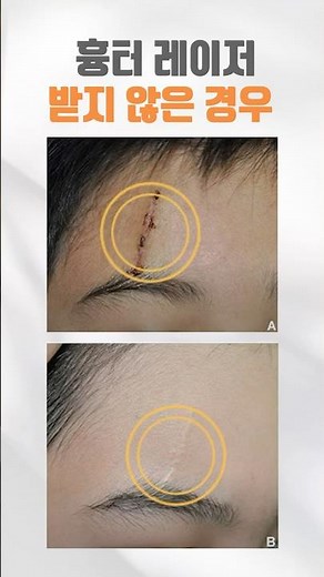 흉터 완벽하게 제거하는 방법 l 오체안 성형외과 x 피부과 협진