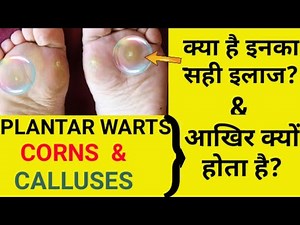 Plantar warts, Corns & Calluses -Causes, Symptoms & Treatment