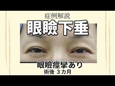 眼瞼痙攣・眼瞼下垂、手術後3か月の症例解説