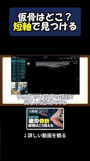 中足骨疲労骨折の仮骨を見つけるコツ #Shorts