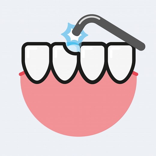 Composite Bonding • Synergy Dental Clinic