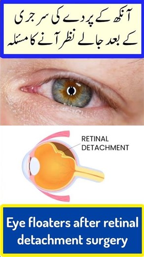 Eye floaters after retinal detachment surgery (Urdu/Hindi)