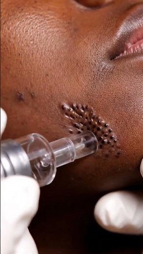 Blackhead Removal Before & After Transformation