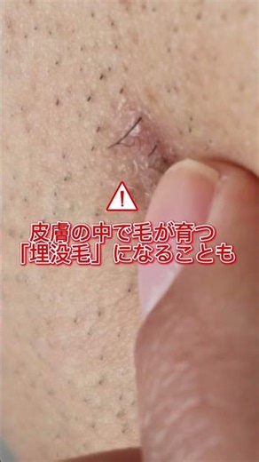 ヒゲの処理、なんとなく毛抜きで済ませていませんか？