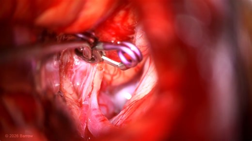 #508: Minipterional Craniotomy for Clipping of an Anterior Communicating Artery Aneurysm - Aneurysm - Seven Series Collection