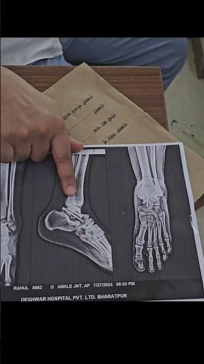 #ankleinjury #anklepain talus bone fracture recovery #bonefracture