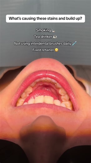 Prevent Stains and Build-up: Dental Hygienist Tips