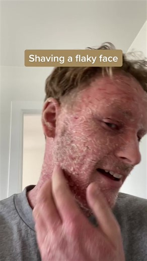 ctrl.skin (@ctrl.skin) - Shaving my flaky face ? #shaveitoff #shaving #topicalsteroidwithdrawal #tsw #nomoisturetreatment #nmt #ctrlskin #fyp #ezcema