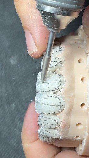 Veneers feldspathic | Mohammed Hamidi