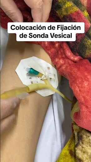 COLOCACIÓN DE FIJACIÓN DE SONDA VESICAL