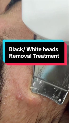 Effective Black and Whitehead Removal Treatment
