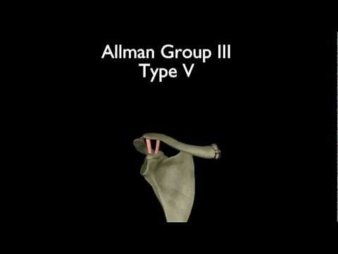 Clavicle Fractures: Classification and Surgical Indications