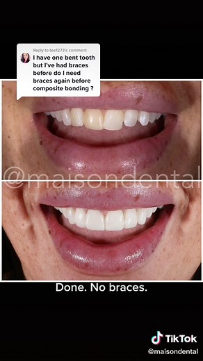 Fix Overlapping Front Teeth with Composite Bonding