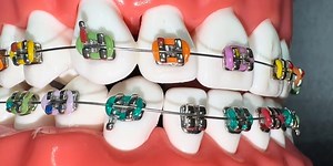 Why are braces bad?