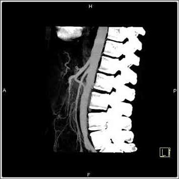 Abdomen: Stomach: SMA Syndrome: Vascular mapping(1 of 7)