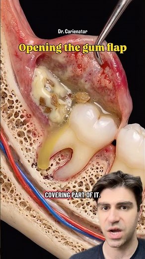 Stop Wisdom Tooth Pain WITHOUT Pulling Them!