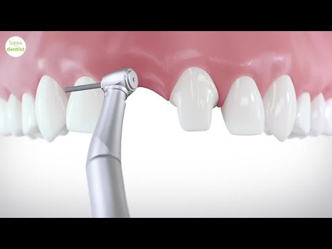 Dental Implant vs. Bridge: Which is Best for You? | Sabka Dentist Explains
