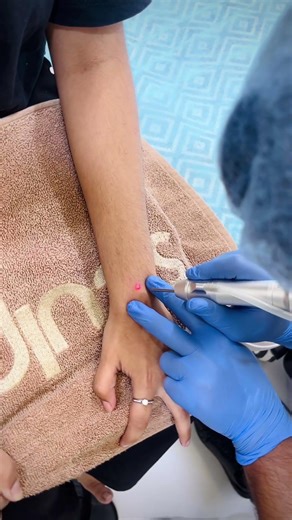 Say goodbye to unwanted moles for good! ✨ #MoleRemoval, #LaserTreatment, #ClearSkin