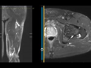 Hamstring tear in water skier