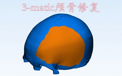 Mimics、3-matic颅骨修复、假体设计标准教程1