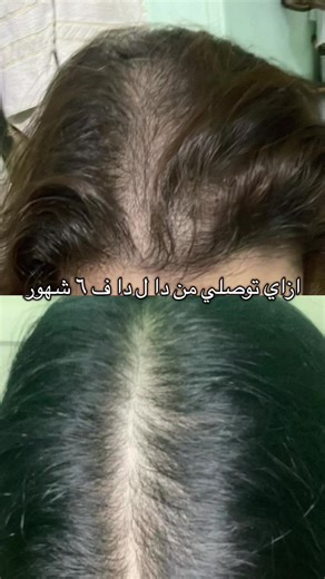 Transforming Female Pattern Baldness in 6 Months