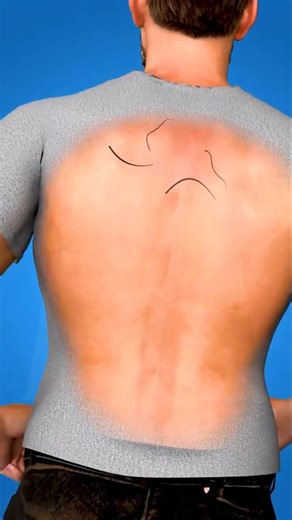 Pilonidal Cyst Formation Explained | How Hair Causes Pilonidal Cyst