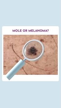 Mole or Melanoma?