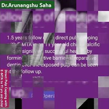 Dr.Arunangshu Saha, Direct pulp Capping with E-MTA to 11 yrs old girl, 😁👌👌👌