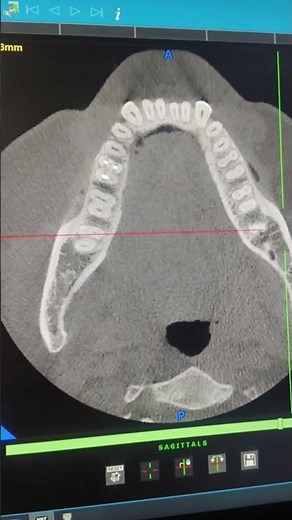 Unbelievable Results! Dr. Abhishek Pati's CBCT 3D Scan Revolutionizes Small Cavity Detection!