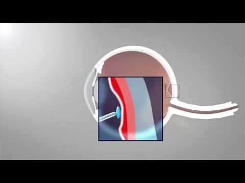 Netzhaut Operation (Animation)