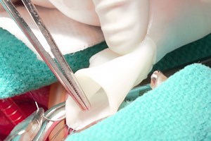 Artificial blood vessels developed in the lab can grow with the recipient