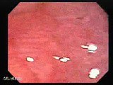 Tubulo-Villous Adenoma (2 of 6) • Video • MEDtube.net
