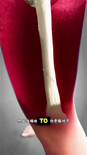 What Happens If Your Leg Is Hit With a Hammer? 😱 Real Bone Surgery Explained