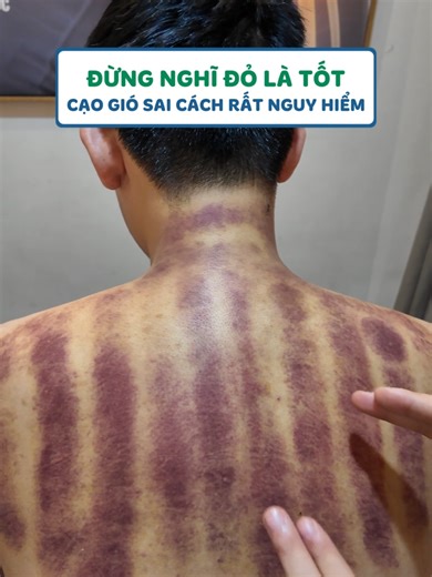 ĐỪNG NGHĨ ĐỎ LÀ TỐT CẠO GIÓ SAI CÁCH RẤT NGUY HIỂM #virals #coxuongkhop #covaigay #suckhoe #caogio #luca #kienthucsuckhoe