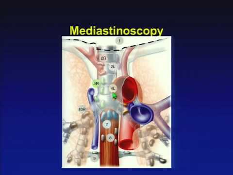 The Role of EBUS in Lung Cancer Staging