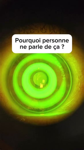 Voir parfaitement… sans lunettes, sans lentilles, sans chirurgie 👁️✨ C’est possible grâce à l’orthokératologie (Ortho-K). 👉 Des lentilles portées uniquement la nuit 👉 Qui remodèlent temporairement la cornée pendant le sommeil 👉 Pour une vision nette toute la journée 💡 Solution non chirurgicale 💡 Réversible 💡 Utilisée aussi pour ralentir la progression de la myopie, surtout chez l’enfant 💡 Plus on commence tôt, plus c’est efficace ⚠️ Mais attention : Cette technique ne convient pas à tous