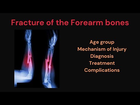 Forearm Both Bone fracture | Fracture forearm bone: Mechanism of injury, Treatment & complications