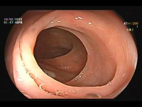 colonoscopy / polypectomy