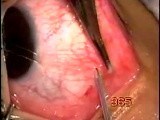 Recession and resection • Video • MEDtube.net