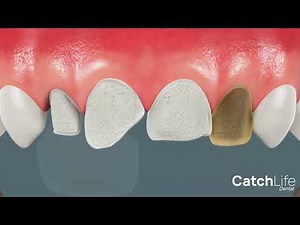 Dental Veneers Procedure Demonstration