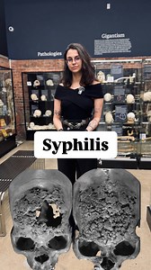 394K views · 78K reactions | What does syphilis do to your bones? In its tertiary stage, syphilis can leave behind unmistakable marks—especially on the skull and femur. From caries sicca (pitting and scarring of the skull) to periosteal irritation, this bacterial infection doesn’t just attack soft tissue—it reshapes bone. Let’s break down the bony aftermath. #syphilis #bone #infection | The Bone Museum | Facebook