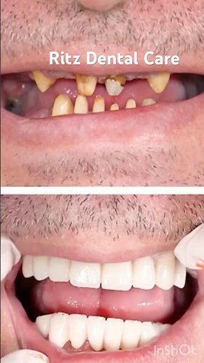 “Dental Caps For Upper And Lower Jaw!”