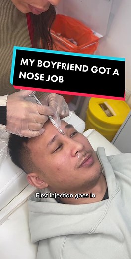 Non Surgical Nose Job Transformation | Best Filler & Botox Experience