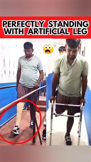 Above Knee Prosthesis | Ossur Hydraulic Knee | #ossur #ottobock #3r80 #ossur #shorts #prosthetics